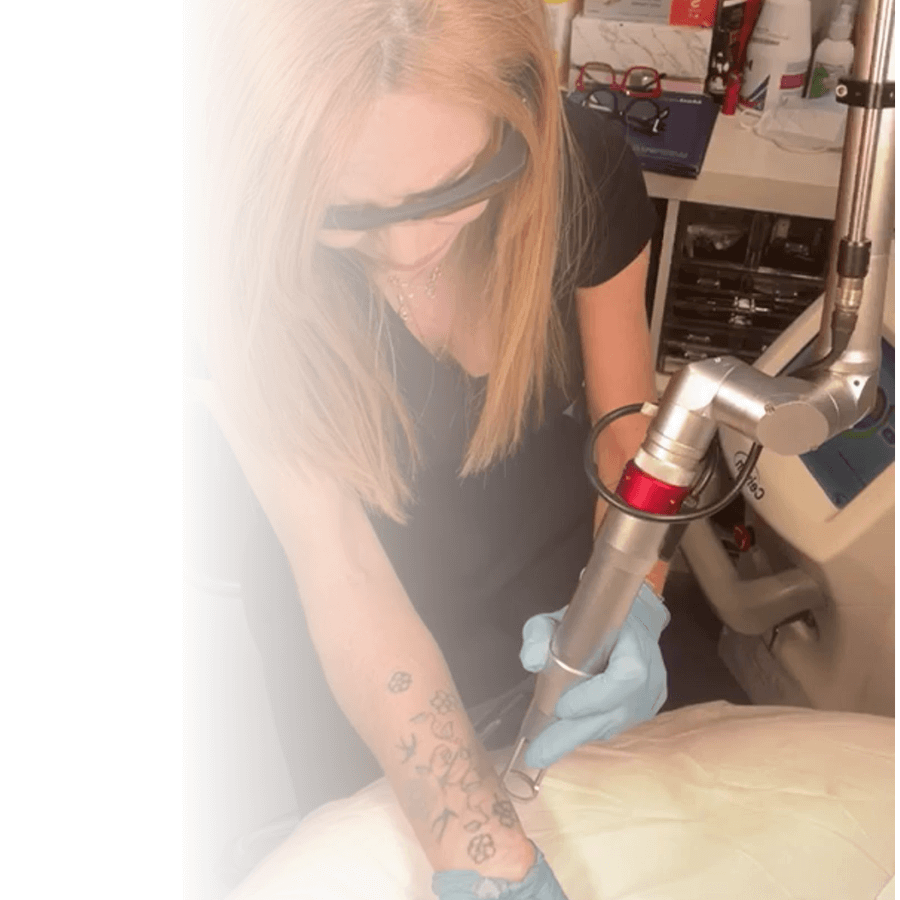 eliminacion de tatuajes en arganda