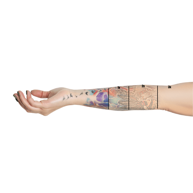 borrar tatoosuajes arganda